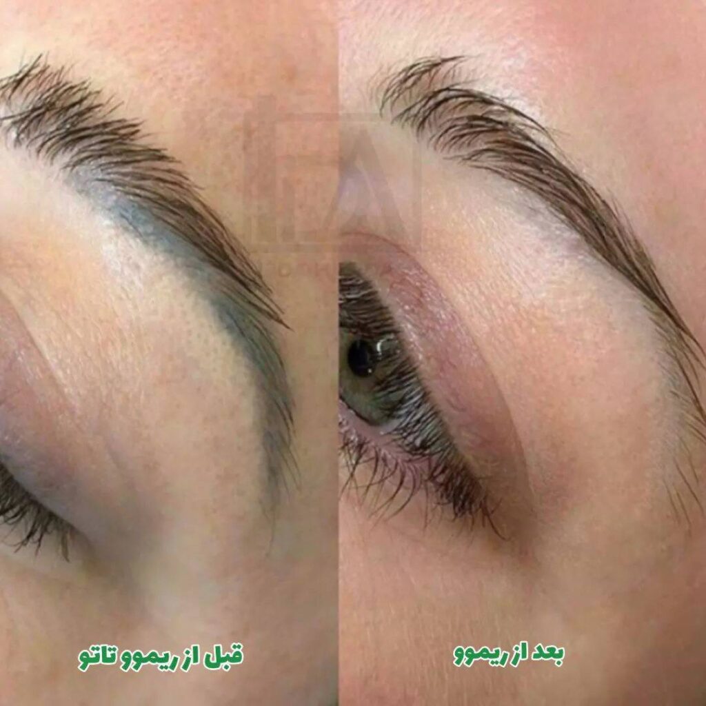 میکروبلیدینگ