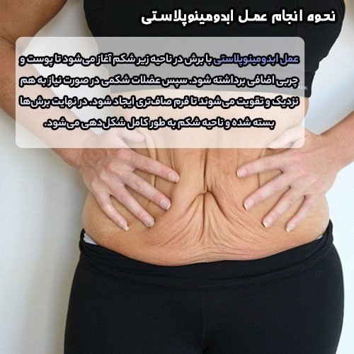 نحوه انجام عمل ابدومینوپلاستی