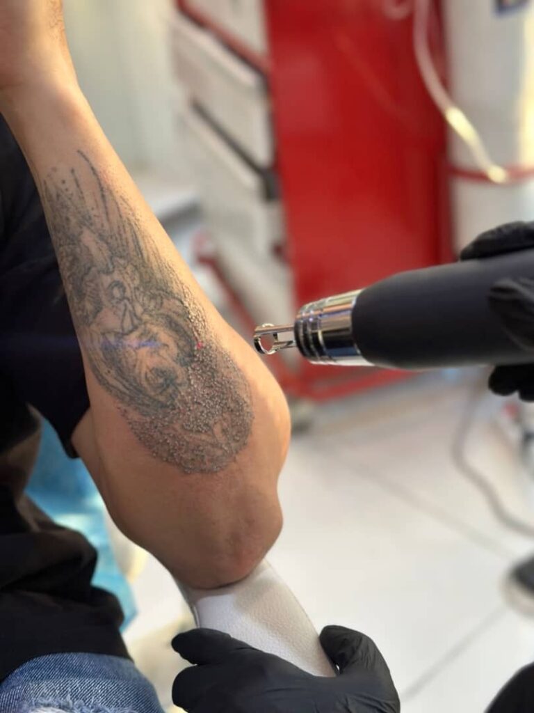 ریموو تتو کلینیک آیشیل