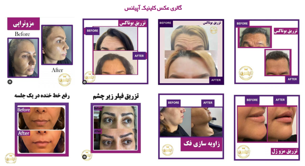 سالن مزوتراپی مو آپیلنس